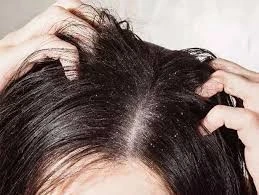 5.Health_Tips_-Simple_advice_for_dandruff