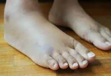 ಊತ (ಊದಿಕೊಂಡಿದ್ದರೆ)ಕ್ಕೆ ಮನೆಮದ್ದು