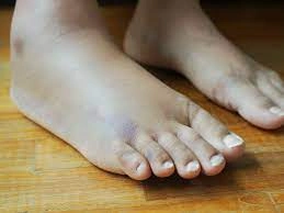 ಊತ (ಊದಿಕೊಂಡಿದ್ದರೆ)ಕ್ಕೆ ಮನೆಮದ್ದು