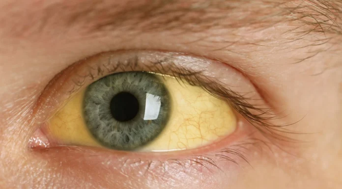 ಅರಿಶಿನ ಕಾಮಾಲೆ, ಯಕೃತ್ತು ದೋಷಕ್ಕೆ ಮನೆಮದ್ದು