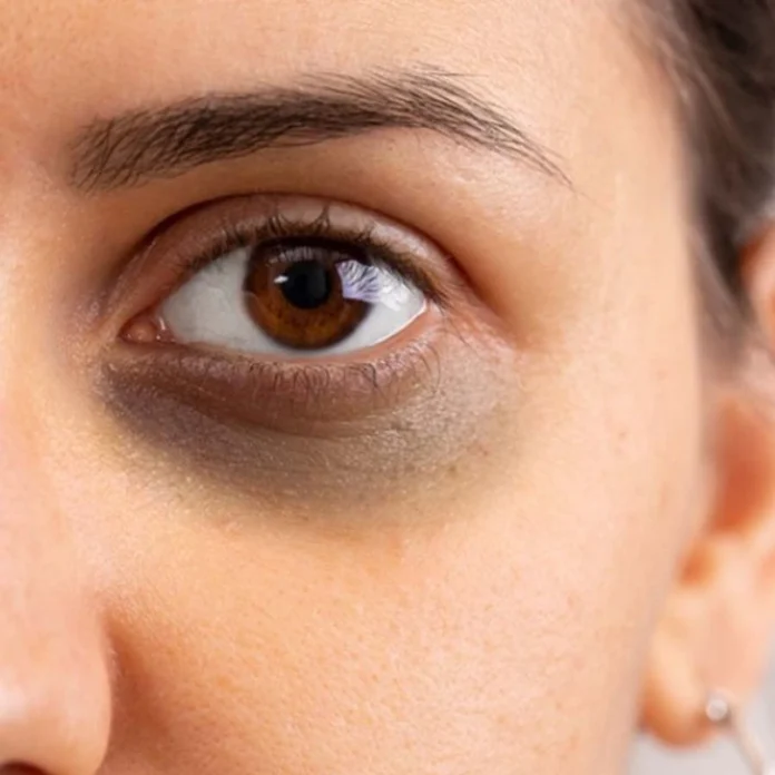 11.Health Tips -Is dark circles under the eyes a problem