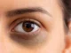ಕಣ್ಣಿನ ಕಪ್ಪು ಕಲೆ ಸಮಸ್ಯೆಯೇ…