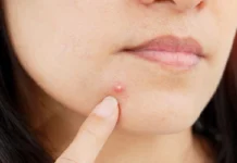 ಮೊಡವೆಗೆ ಮನೆ ಮದ್ದು