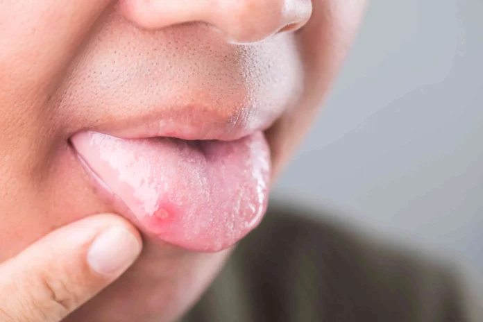 9.Health Tips -Home remedies for tongue health